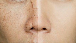 Before and After Retouching Freckles on Asian Woman Face, Skin Problems