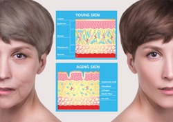 The younger skin and aging skin. elastin and collagen. A diagram of young and old face showing the decrease in collagen and broken elastin.