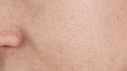 macro enlarged pores. pale skin, cosmetology.