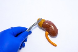 A model of a human kidney with an adrenal gland is on a table, above it is the surgeons hand with a scalpel. Adrenal gland surgery concept photo