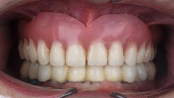 removable dental prosthesis of the upper jaw of low quality before total implantation