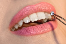 Dentist doctor select a gem or rhinestone for the patient’s teeth, Mouth close up