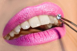 Dentist doctor select a gem or rhinestone for the patient’s teeth, Mouth close up. Shiny deep magenta-pink lip color