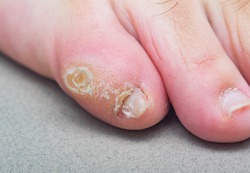 Large dry callus on the little toe of a man's foot. Consequences of wearing uncomfortable, tight shoes.