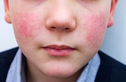 8 years old child with red cheeks- enterovirus infection, diathesis or allergy symptoms. Redness and peeling of the skin on the face. 