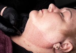 Fibroblast, plasmalifting procedure womens neck wrinkles lifting