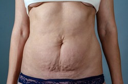 Abdominal skin of a woman with stretch marks after childbirth