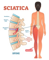 Sciatica medical health care vector illustration scheme with lower spine and sciatic nerve pain in leg. Backbone diagram with vertebrae, disks and nerves. Full woman patient body from back.