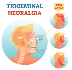 Trigeminal neuralgia medical cross section anatomy vector illustration diagram with facial neural network and pain areas.Head neurology scheme with ophthalmic, maxillary and mandibular branches.