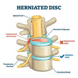Herniated disc injury 3D side view on spinal bone skeleton vector illustration. Medical condition with back trauma pain and nerve root compression by nucleus pulposus. Problematic example comparison.