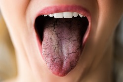 Woman Tongue With Bad Bacteria Candidiasis And Pain