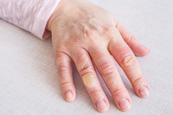 Hand with second degree burns on the fingers