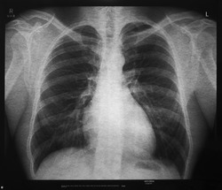 Medical X-ray featuring male chest. Black and white image. Lower neck and shoulders can be seen with lungs and ribcage. 