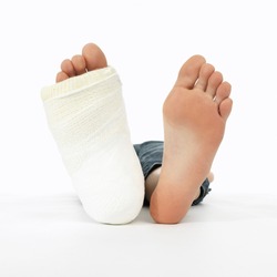 girl with a broken leg (close-up of feet, one with a plaster bandage)