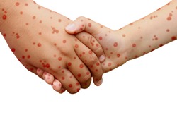 Measles disease concept and viral illness as a contagious chickenpox or a skin rash.