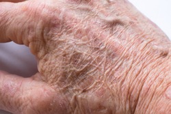 Close up of the wrinkled skin on the hand of an older man with some lesions of actinic keratosis or sunspots