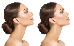Woman Rhinoplasty. Women Nose Shape Before and After Plastic Surgery. Beauty Model Profile Side View over isolated White background