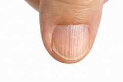 Vertical ridges on the fingernails symptoms deficiency  vitamins and minerals