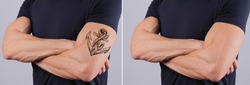 Man before and after laser tattoo removal treatment