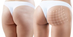 Female buttocks with arrows grid before and after plastic surgery.