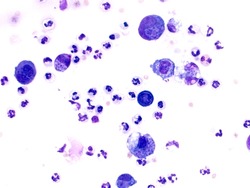  Toxoplasmosis with Toxoplasmsa gondii within macrophages from a cytology smear. Clusters of parasitic organisms are within macrophages.
