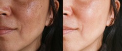 Before and after facial treatment concept. Face with melasma and brown spots and open pores. 