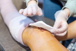 Cleaning and dressing incision and stitches after surgery