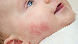 Closeup of baby face skin with pimples and acne from dermatitis. Concept of newborn baby hygiene, health and skin care.