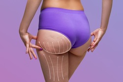 Buttocks liposuction, fat and cellulite removal concept, overweight female body with painted surgical lines and arrows on a purple background with a gradient