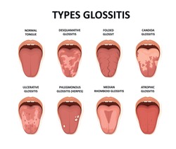 Types glossitis. Tongue disease illustration