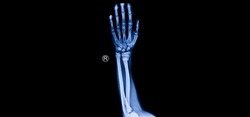 A photo of plain radiograph on dark background in hospital. The film use for diagnosis the illness of patient.Medical concept. A children with fracture distal radius bone. A green stick fracture.