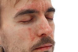 head of sick man with closed eyes with red allergic reaction on facial skin, redness and peeling psoriasis on nose, forehead and cheeks, seasonal skin problem, side view, white background