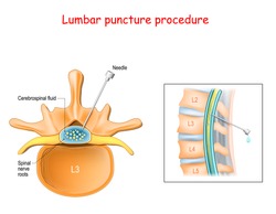 Lumbar puncture procedure. Spinal nerve roots. Spinal Tap Procedure. close-up of Vertebral Column. Syringe needle inserted into Epidural space to Collect Cerebrospinal Fluid. Vector 