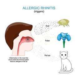 Allergic rhinitis. Inflammation in the nose that occurs when the immune system reacts to allergens in the air. triggers: dust, pollen, and pet hair. Cross section of human nose.