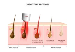 Laser hair removal. The melanin absorbs the light and heats up, Hair to fall out. Vector diagram about skin and hair condition Before procedure, After the treatment and during Treatment session.