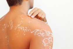 Peeling skin dermatology conditions at man back and shoulder, flaking skin and skincare concept

