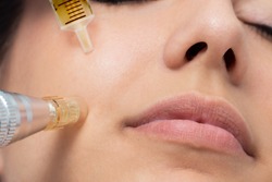 Macro detail of micro needle cosmetic treatment on female cheek. Derma pen and syringe with plant extracts next to face.