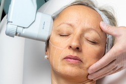 Top view of woman having cosmetic facial high intensity focal ultrasound treatment on side of face.