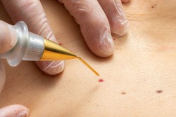Macro close up detail of laser plasma pen removing cherry angioma on human skin.