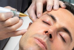 Close up detail of laser plasma pen removing facial moles on middle aged man.