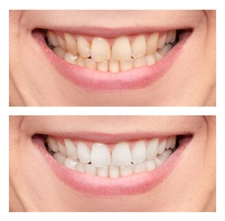Close up of female mouth. Comparison after teeth whitening