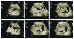 Compilation of six ultrasound scans of baby twins in utero at 12 weeks with scans of the twins together and seen separately 