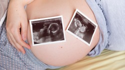 Pregnant woman holding her tummy with two ultrasound scans of twins on her belly