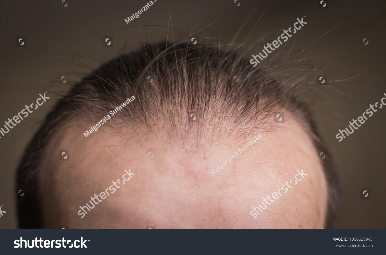 baldness-receding-hair-on-head-young-stock-photo-1006638943-shutterstock