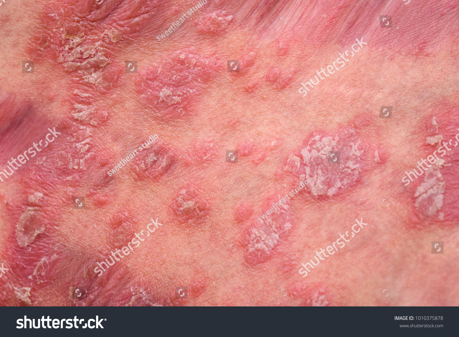 Psoriasis Skin Psoriasis Autoimmune Disease That Stock Photo 1010375878 ...