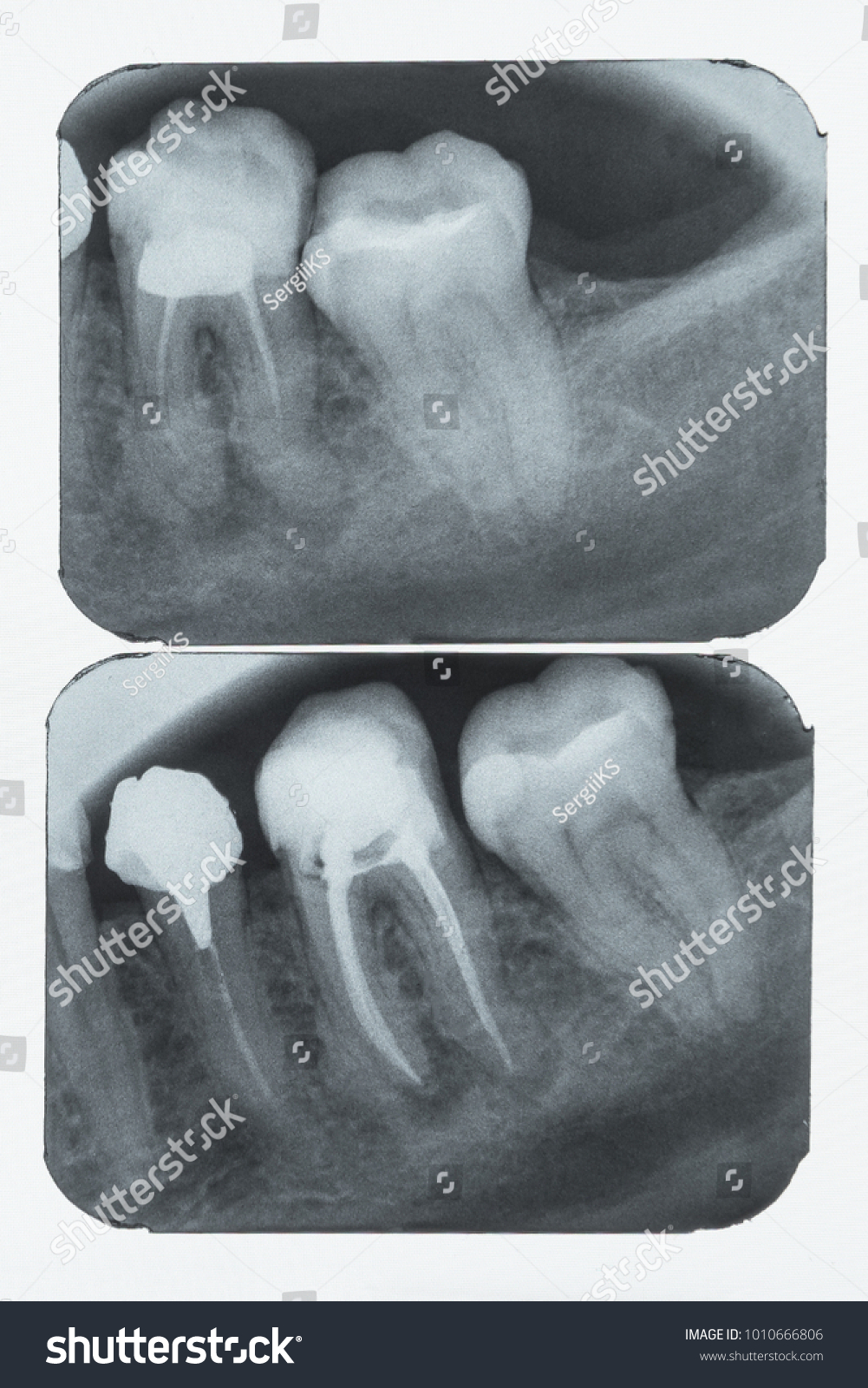 Photo Xray Images On Xray Film Stock Photo 1010666806 | Shutterstock