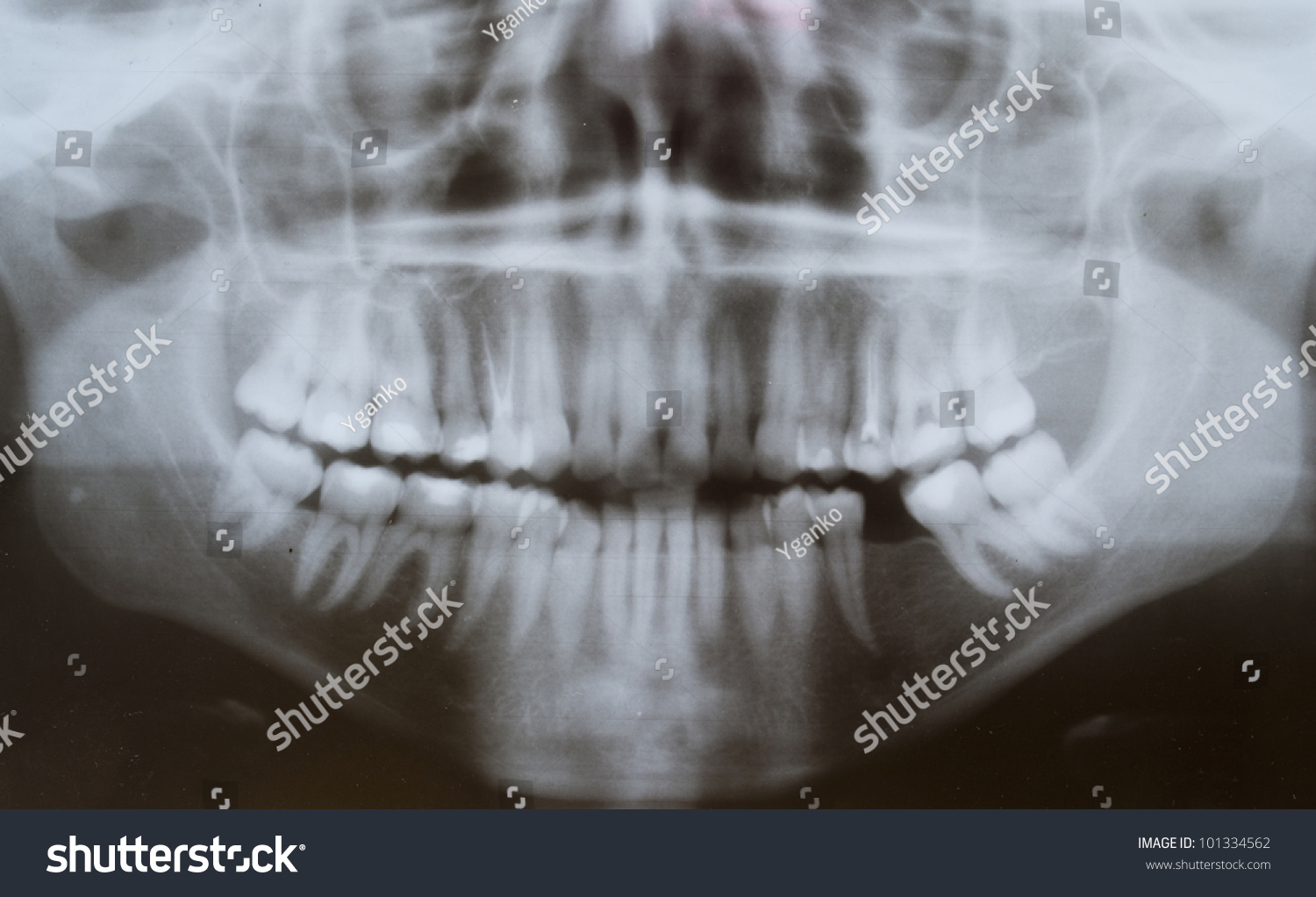 Xray Panoramic Picture Jaw Stock Photo 101334562 