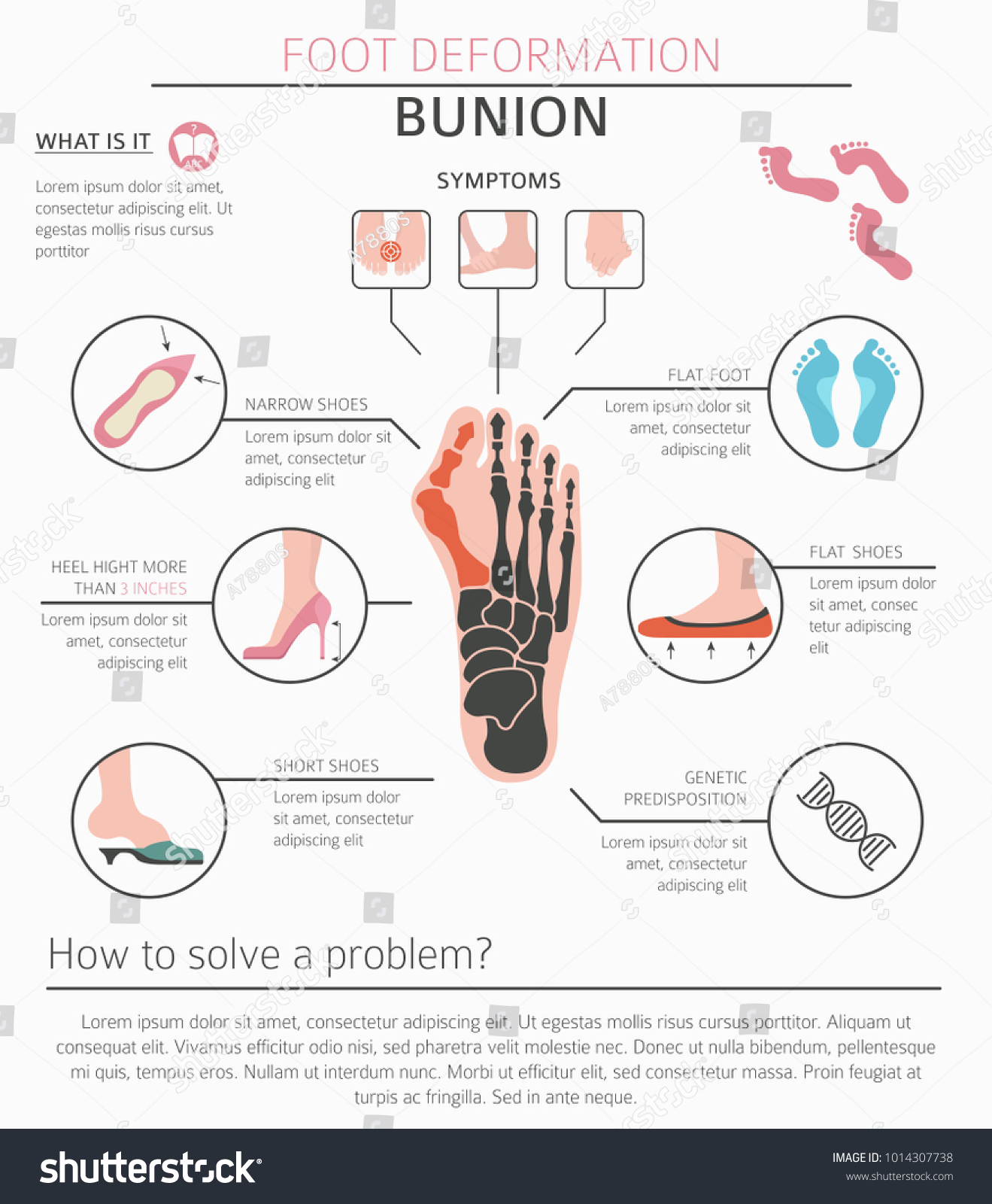 Foot Deformation Medical Desease Infographic Causes Stock Vector ...