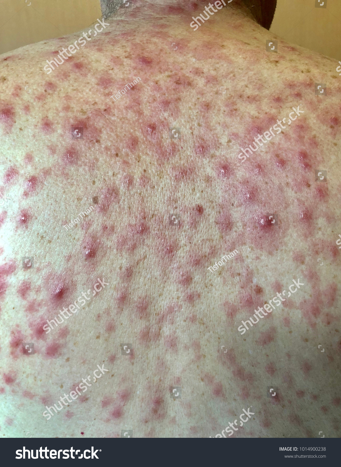 maculopapular rash hiv