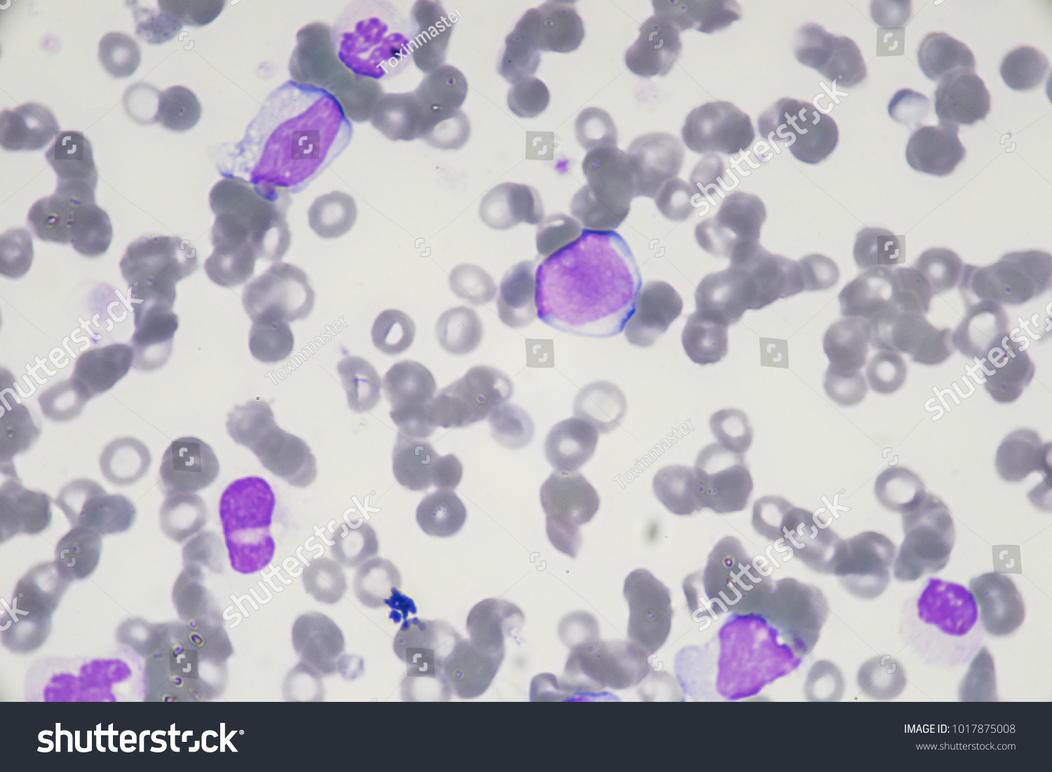 Acute Myeloblastic Leukemia Blood Smear Blast Stock Photo 1017875008 ...